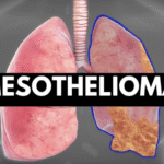 Mesothelioma Attorney Specialized in Asbestos Cases