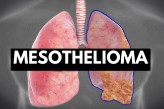 Mesothelioma Attorney Specialized in Asbestos Cases