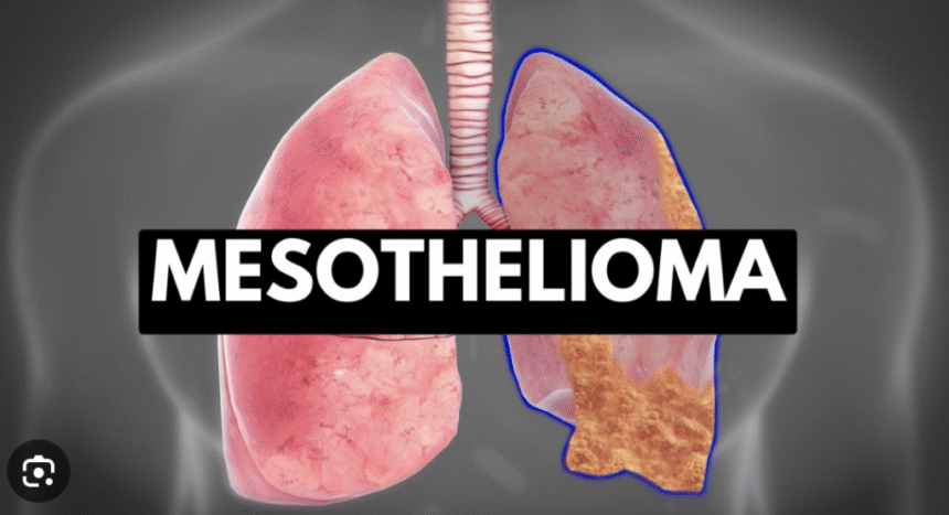 Mesothelioma Attorney Specialized in Asbestos Cases